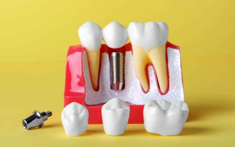 Dental Crowns Safer Than Implants