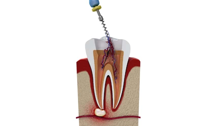 what to do if a root canal gets infected
