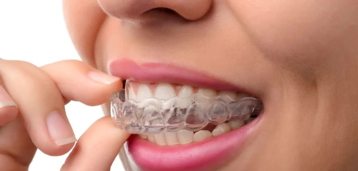How To Use Invisalign For Effective Teeth Straightening