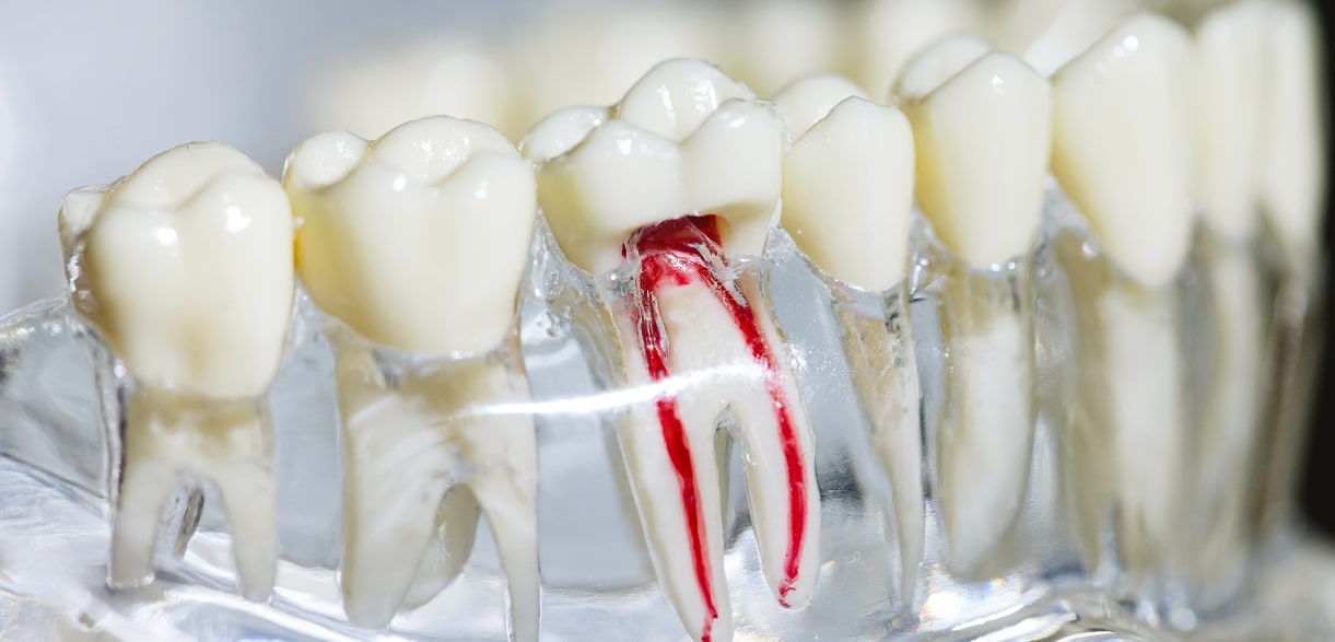 can a root canal be necessary for damaged teeth