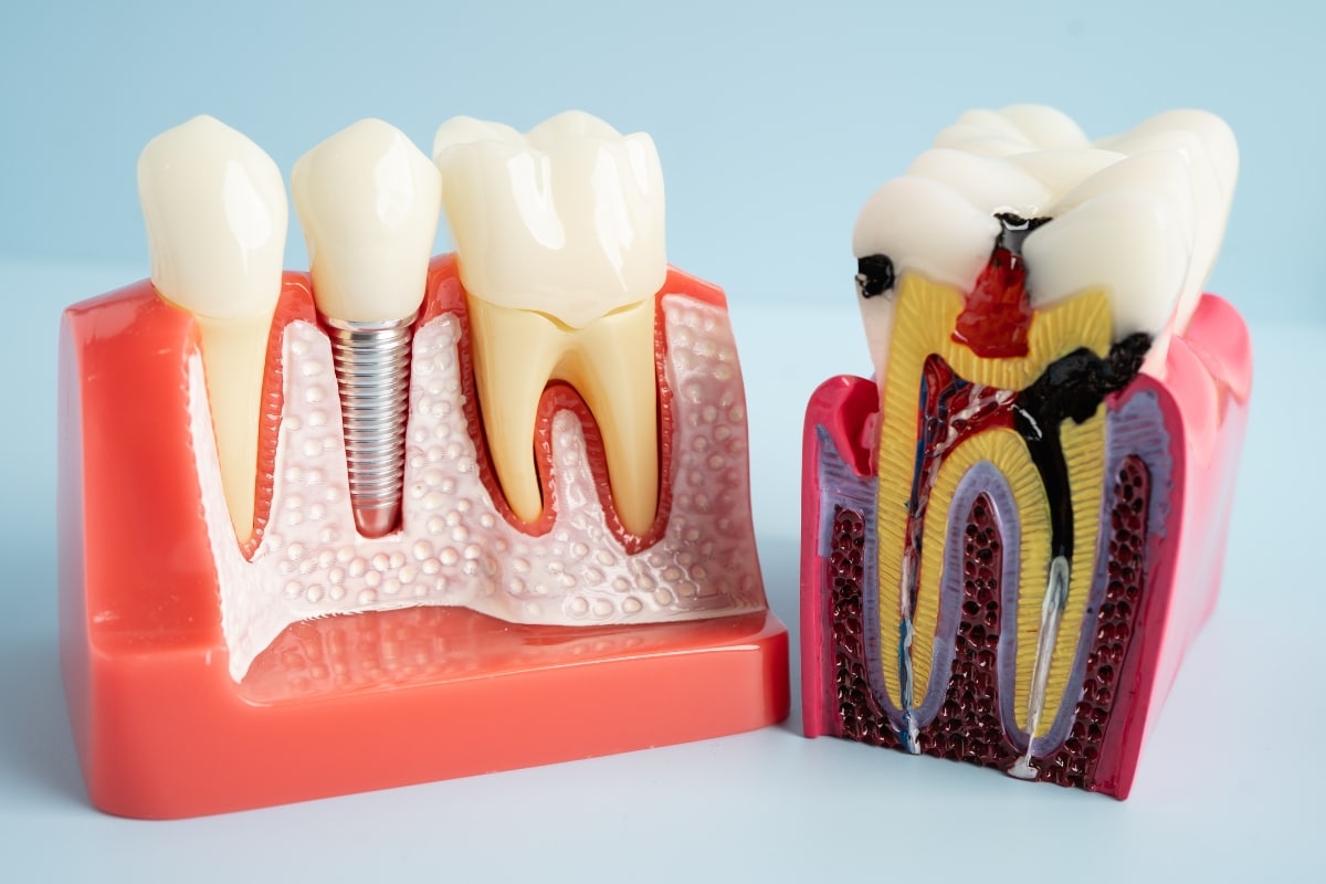 Connection-Between-Bone-Grafting-and-Dental-Implants