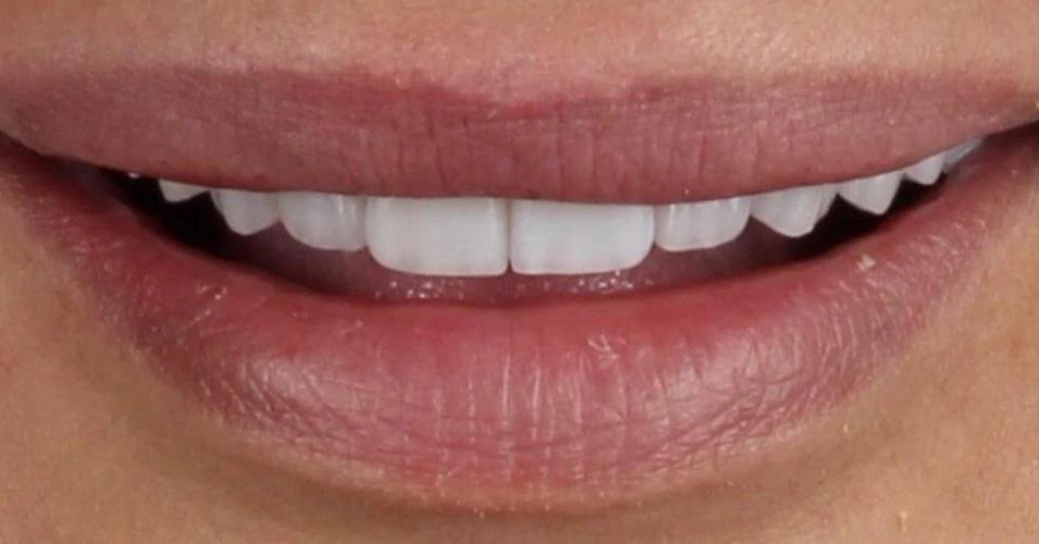 smilegallery after image