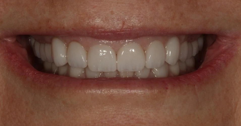 smilegallery after image