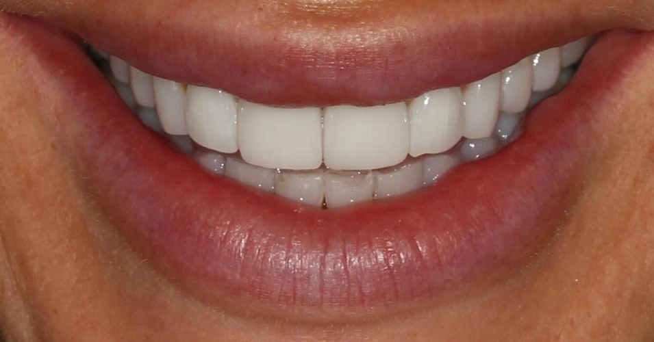 smilegallery after image