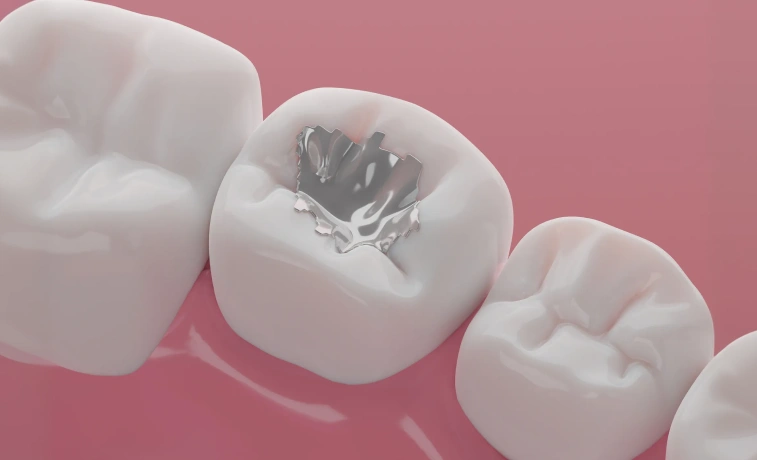 composite-filling-img