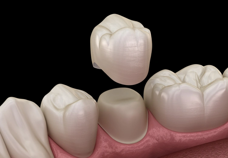 crown-bridges-process-image