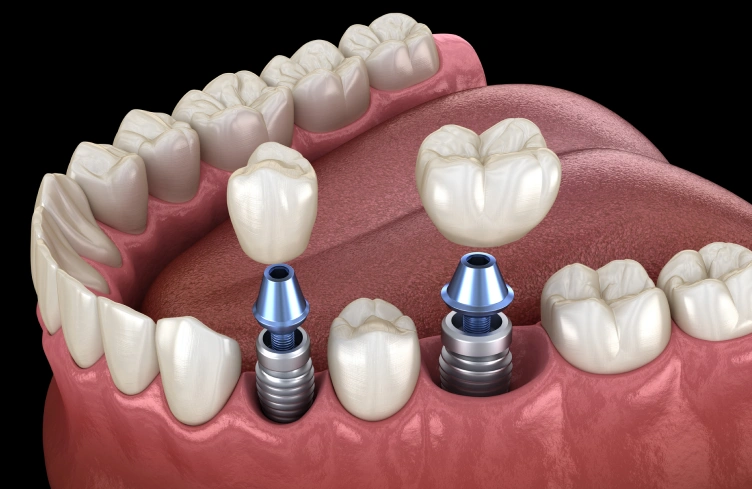 dental-implants-process-image