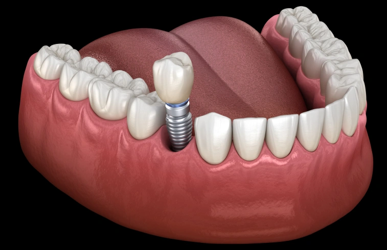 image-dental-implants